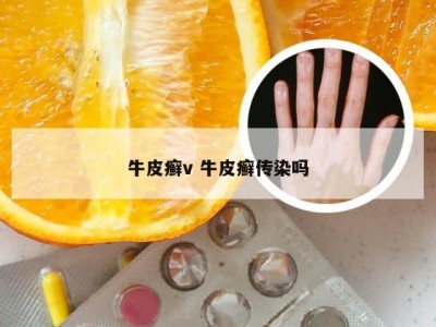 牛皮癣v 牛皮癣传染吗