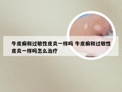 牛皮癣和过敏性皮炎一样吗 牛皮癣和过敏性皮炎一样吗怎么治疗