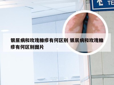 银屑病和玫瑰糠疹有何区别 银屑病和玫瑰糠疹有何区别图片