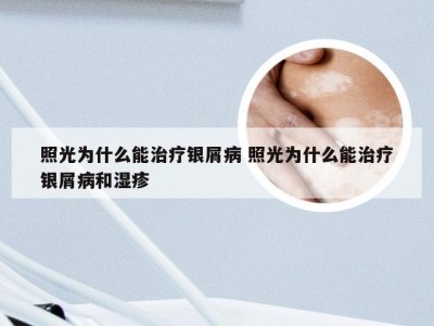 照光为什么能治疗银屑病 照光为什么能治疗银屑病和湿疹