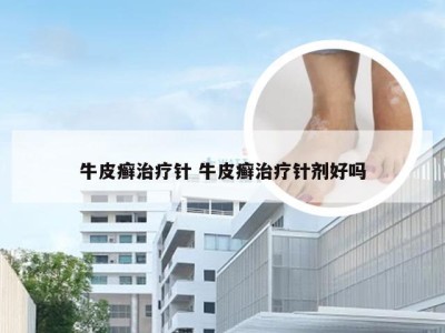 牛皮癣治疗针 牛皮癣治疗针剂好吗