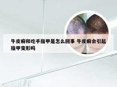 牛皮癣和吃手指甲是怎么回事 牛皮癣会引起指甲变形吗