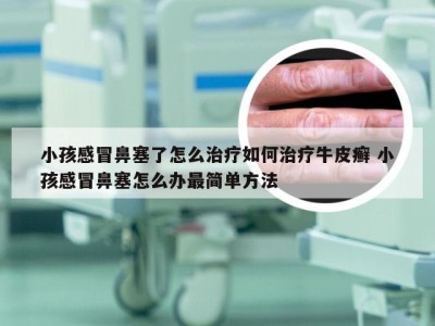 小孩感冒鼻塞了怎么治疗如何治疗牛皮癣 小孩感冒鼻塞怎么办最简单方法