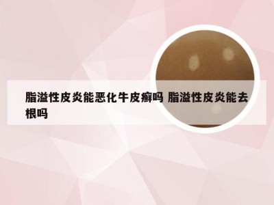脂溢性皮炎能恶化牛皮癣吗 脂溢性皮炎能去根吗