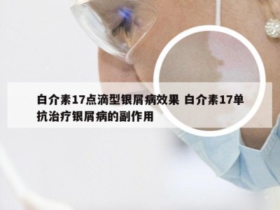 白介素17点滴型银屑病效果 白介素17单抗治疗银屑病的副作用