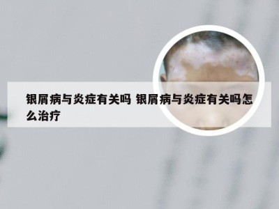 银屑病与炎症有关吗 银屑病与炎症有关吗怎么治疗