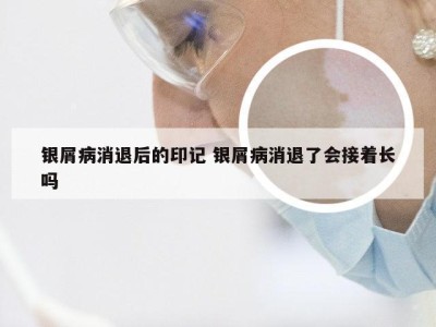 银屑病消退后的印记 银屑病消退了会接着长吗