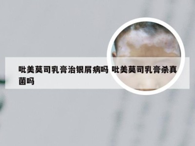 吡美莫司乳膏治银屑病吗 吡美莫司乳膏杀真菌吗
