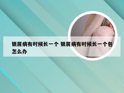 银屑病有时候长一个 银屑病有时候长一个包怎么办