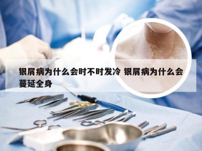银屑病为什么会时不时发冷 银屑病为什么会蔓延全身