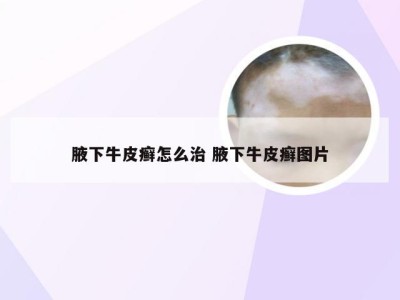 腋下牛皮癣怎么治 腋下牛皮癣图片