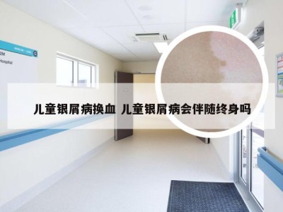儿童银屑病换血 儿童银屑病会伴随终身吗