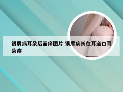 银屑病耳朵后面痒图片 银屑病长在耳道口耳朵疼