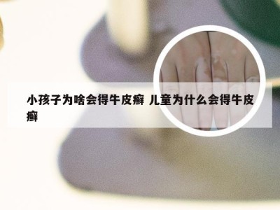 小孩子为啥会得牛皮癣 儿童为什么会得牛皮癣