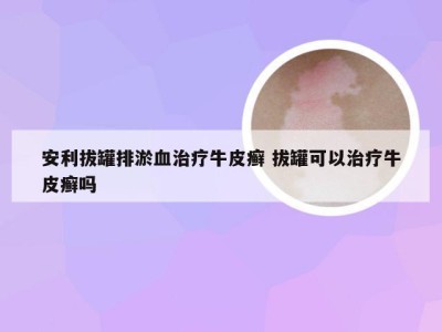 安利拔罐排淤血治疗牛皮癣 拔罐可以治疗牛皮癣吗