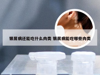 银屑病还能吃什么肉类 银屑病能吃哪些肉类