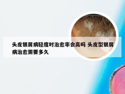 头皮银屑病轻度时治愈率会高吗 头皮型银屑病治愈需要多久