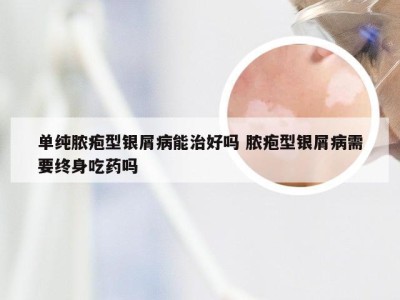 单纯脓疱型银屑病能治好吗 脓疱型银屑病需要终身吃药吗
