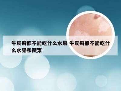 牛皮癣都不能吃什么水果 牛皮癣都不能吃什么水果和蔬菜
