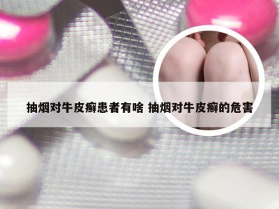 抽烟对牛皮癣患者有啥 抽烟对牛皮癣的危害