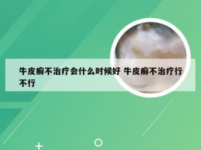 牛皮癣不治疗会什么时候好 牛皮癣不治疗行不行