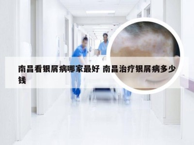 南昌看银屑病哪家最好 南昌治疗银屑病多少钱