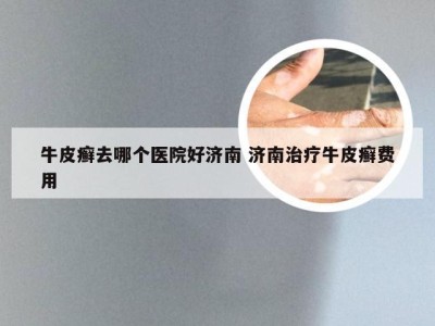 牛皮癣去哪个医院好济南 济南治疗牛皮癣费用