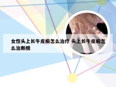 女性头上长牛皮癣怎么治疗 头上长牛皮癣怎么治断根
