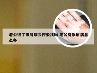 老公得了银屑病会传染我吗 老公有银屑病怎么办