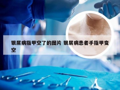 银屑病指甲空了的图片 银屑病患者手指甲变空