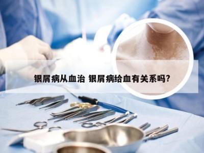 银屑病从血治 银屑病给血有关系吗?