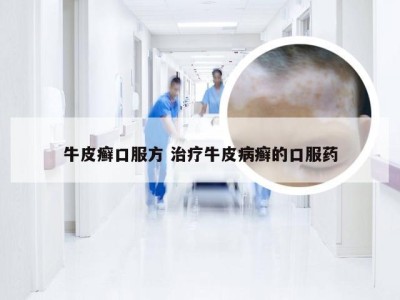 牛皮癣口服方 治疗牛皮病癣的口服药