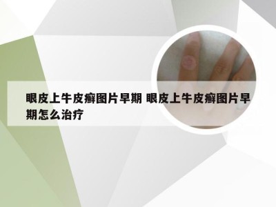 眼皮上牛皮癣图片早期 眼皮上牛皮癣图片早期怎么治疗