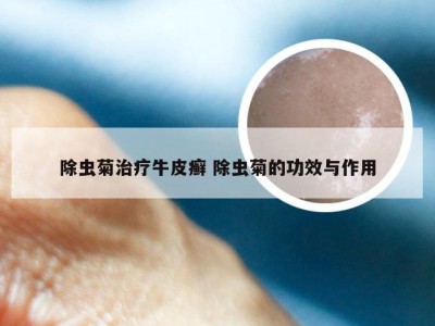 除虫菊治疗牛皮癣 除虫菊的功效与作用