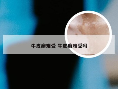 牛皮癣难受 牛皮癣难受吗