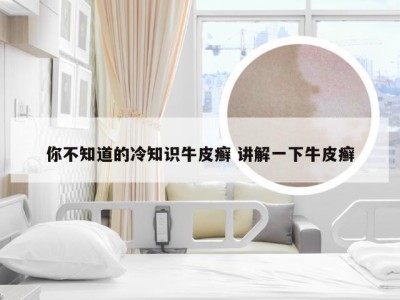 你不知道的冷知识牛皮癣 讲解一下牛皮癣