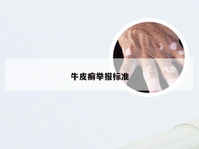 牛皮癣举报标准