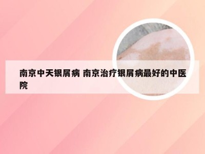南京中天银屑病 南京治疗银屑病最好的中医院