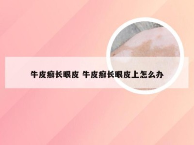 牛皮癣长眼皮 牛皮癣长眼皮上怎么办