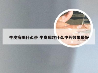 牛皮癣喝什么茶 牛皮癣吃什么中药效果最好