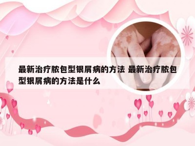 最新治疗脓包型银屑病的方法 最新治疗脓包型银屑病的方法是什么