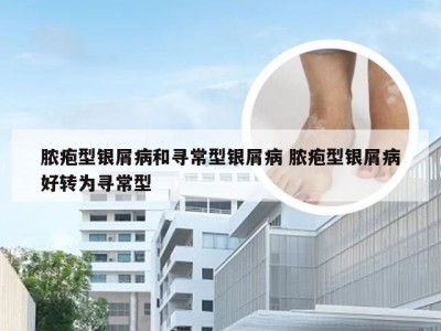 脓疱型银屑病和寻常型银屑病 脓疱型银屑病好转为寻常型