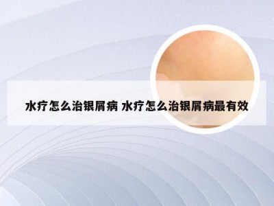 水疗怎么治银屑病 水疗怎么治银屑病最有效