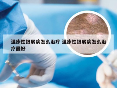 湿疹性银屑病怎么治疗 湿疹性银屑病怎么治疗最好