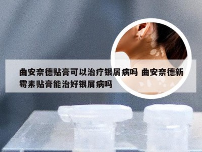 曲安奈德贴膏可以治疗银屑病吗 曲安奈德新霉素贴膏能治好银屑病吗