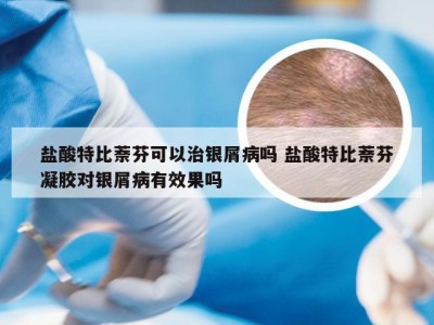 盐酸特比萘芬可以治银屑病吗 盐酸特比萘芬凝胶对银屑病有效果吗