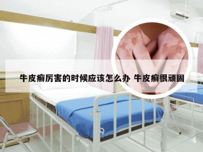牛皮癣厉害的时候应该怎么办 牛皮癣很顽固