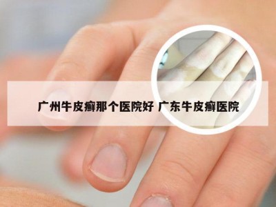 广州牛皮癣那个医院好 广东牛皮癣医院