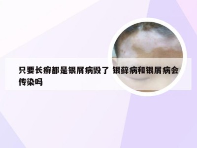 只要长癣都是银屑病毁了 银藓病和银屑病会传染吗