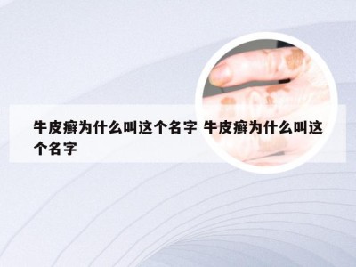 牛皮癣为什么叫这个名字 牛皮癣为什么叫这个名字